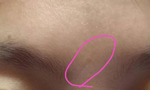 印堂有疤痕的男人命運